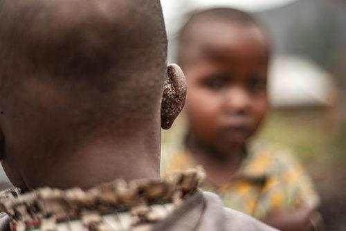 猴痘吃瓜,揭秘病毒传播与防控措施  第2张